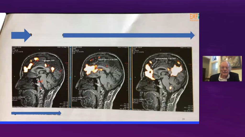 fMRI brain scan